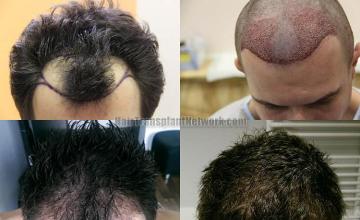 Top view before and after hair restoration results