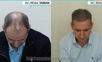 Top view before and after hair restoration results