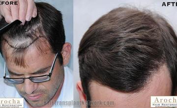 Top view before and after hair restoration results