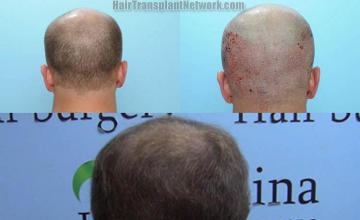  before and after images