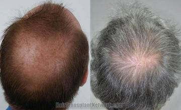 Hair restoration procedure before and after pictures