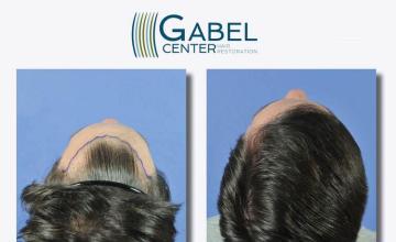 Hair restoration procedure before and after pictures