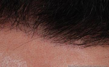 Closeup of hairline after 