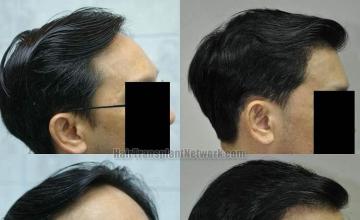 Before and after hair transplant procedure images