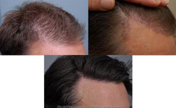 Hair transplantation surgery before and after images