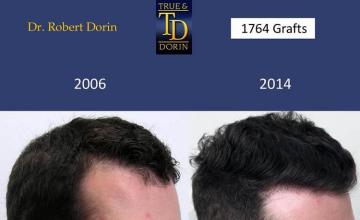 Hair transplantation surgery before and after images