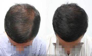 Hair restoration procedure before and after pictures