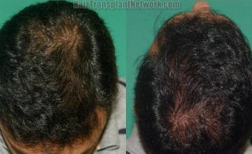 Hair restoration procedure after results