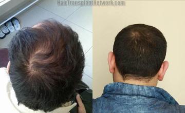 Hair transplant surgery before and after photos