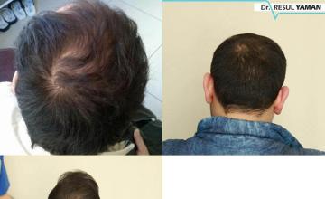 Hair restoration procedure before and after pictures