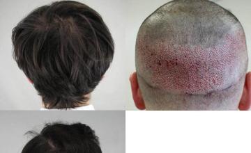 Hair replacement surgery before and after images