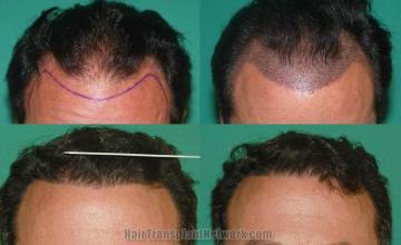 Hair transplantation surgery before and after photos