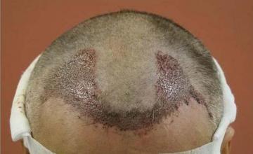 Hair transplantation surgery before and after images