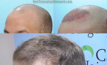  before and after photos