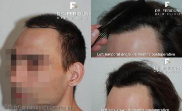 Hair transplantation surgery before and after pictures