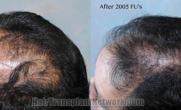 Hair restoration procedure before and after pictures