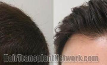 Hair transplantation surgery before and after pictures