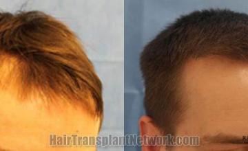 Hair restoration procedure before and after results