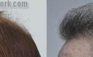 Hair transplantation surgery before and after pictures