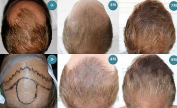 Hair restoration procedure before and after results