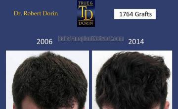 Top view before and after hair restoration results