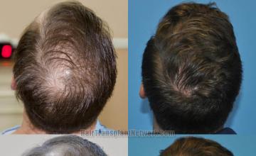 Surgical hair transplantation result photographs