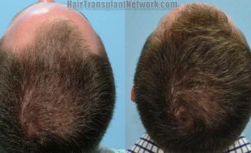 Hair restoration procedure before and after pictures