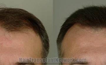 Hair transplantation surgery before and after photos