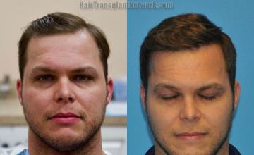 Before and after