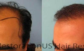 Hair restoration procedure before and after results