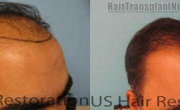 Before and after hair transplant procedure images