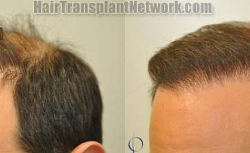 Hair transplantation surgery before and after pictures