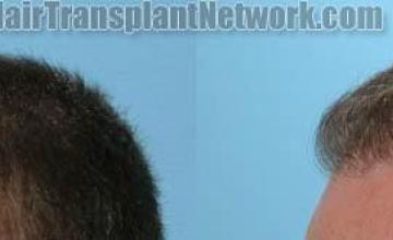 Hair transplantation surgery before and after pictures