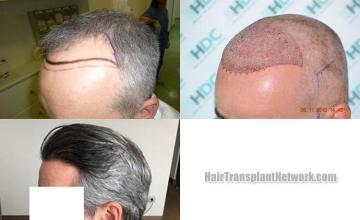 Hair transplantation surgery before and after pictures