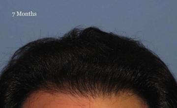 Hair restoration procedure before and after pictures