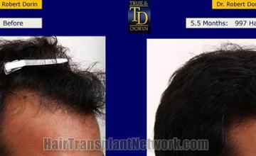 Hair transplantation surgery before and after images