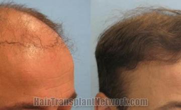 Hair transplantation surgery before and after images