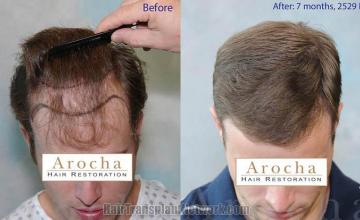 Top view before and after hair restoration results