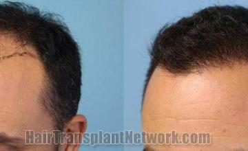 Hair transplantation surgery before and after images