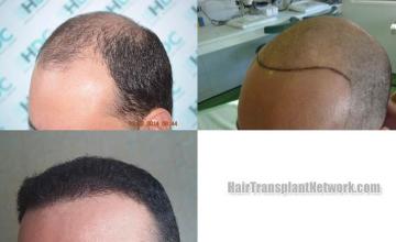 Hair transplantation surgery before and after images