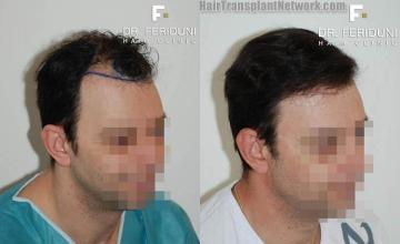 Hair transplantation surgery before and after images