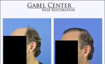 Hair transplantation surgery before and after pictures