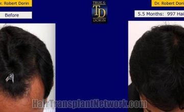 Hair transplantation surgery before and after photos