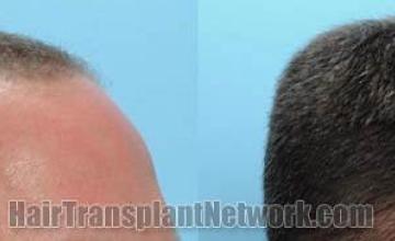 Hair transplantation surgery before and after images