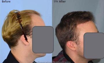 Hair transplantation surgery before and after images