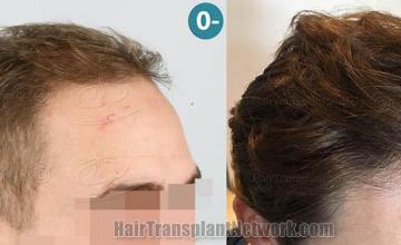  before and after photos