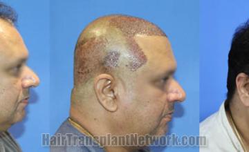 Hair restoration procedure before and after results