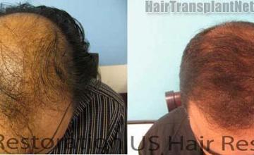 Top view before and after hair restoration results