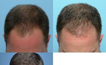 Hair transplantation surgery before and after photos