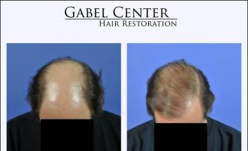 Hair transplantation surgery before and after photos